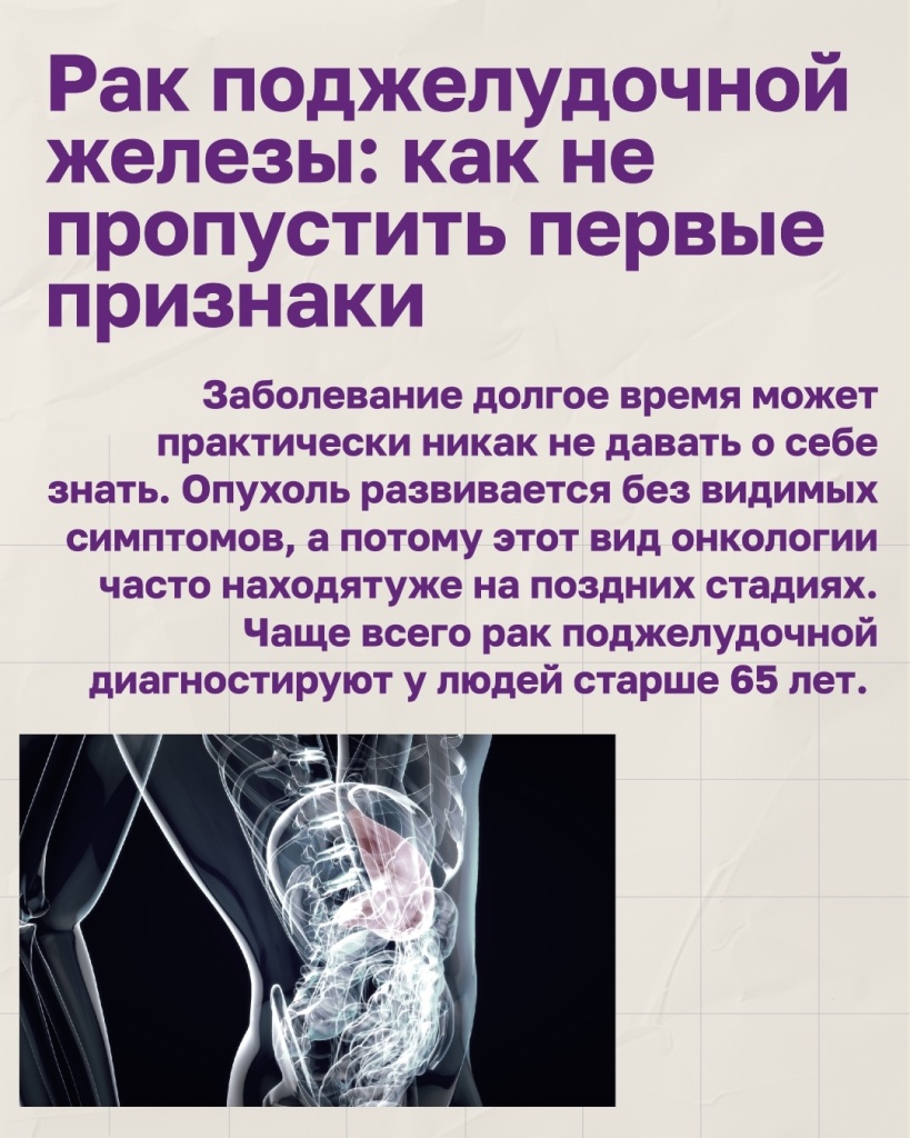 Эксперты ВОНКОЦ предупреждают — рак поджелудочной железы может годами не давать о себе знать